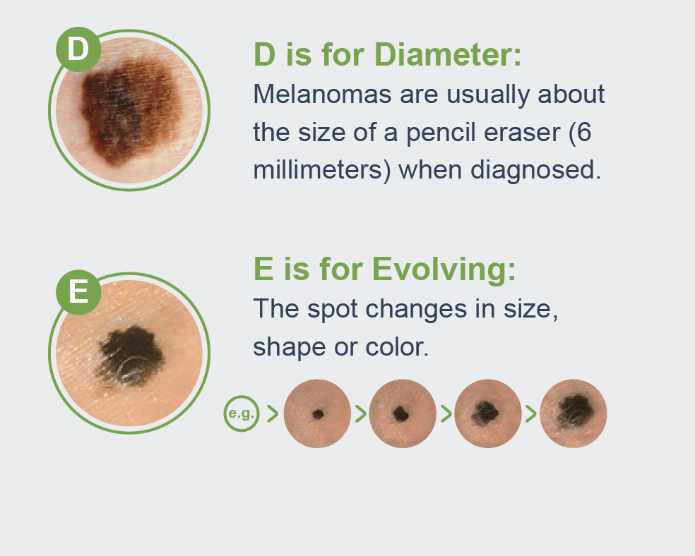 What To Expect At A Full Body Skin Cancer Exam