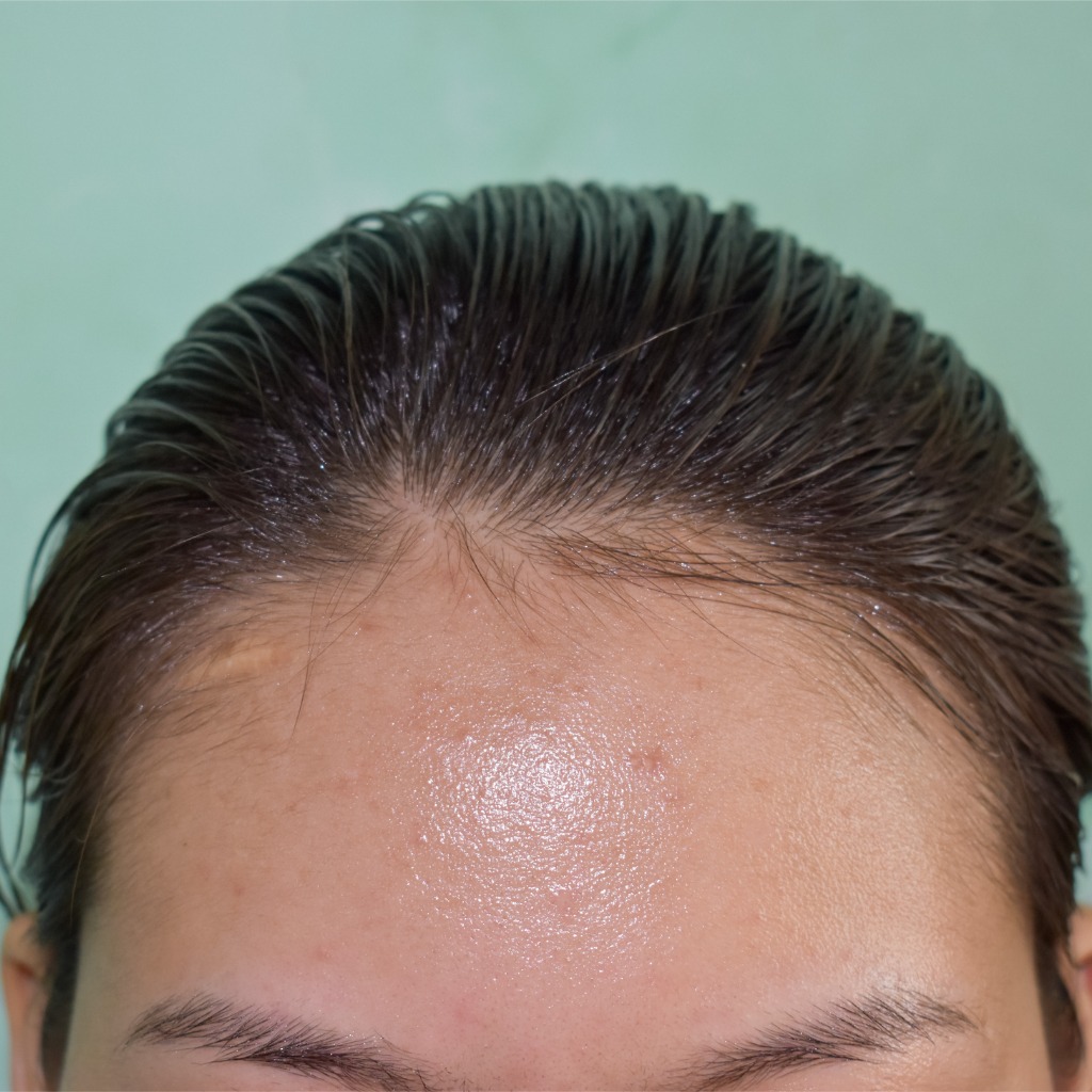 woman with oily skin