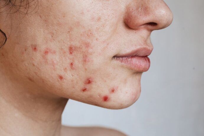 Everything-to-know-about-acne-types-causes-and-treatments