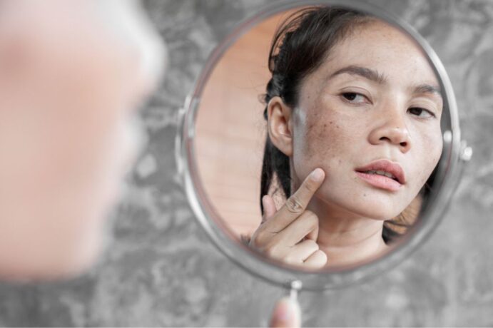 How To Get Rid Of Melasma: Treatments, Skincare, And Prevention