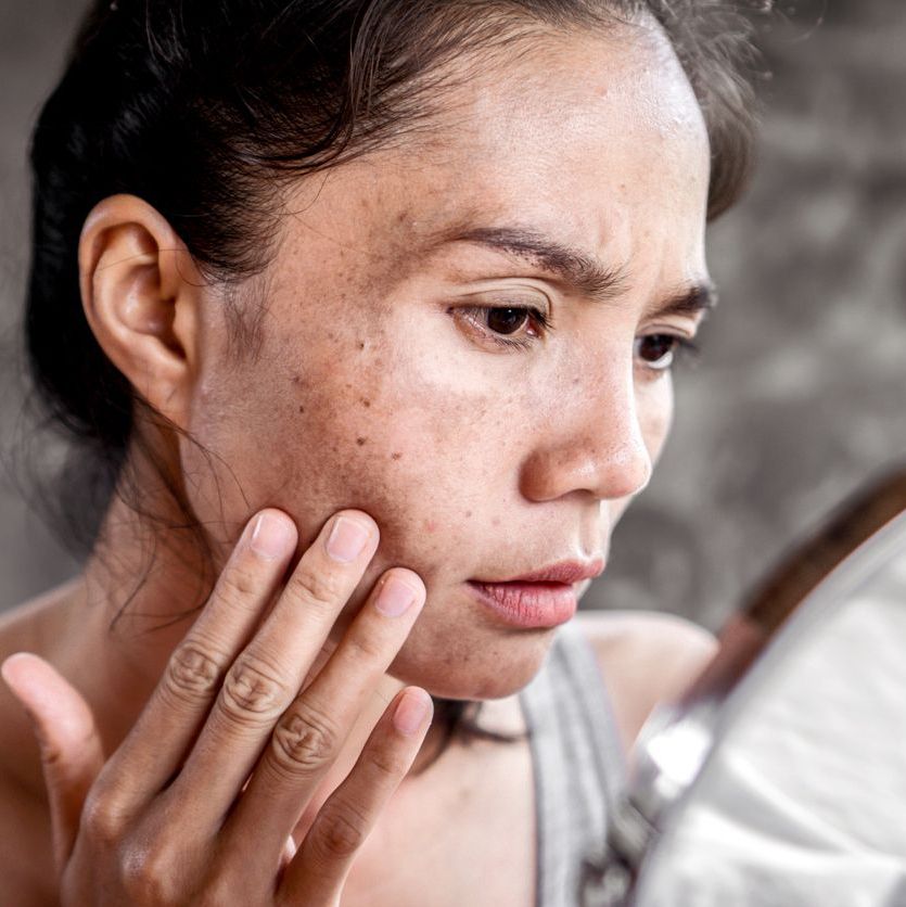 woman looking in mirror seeing melasma on her face, dark spots and pigmentation