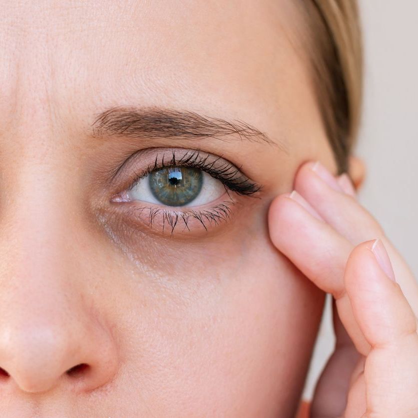 Close up of a young caucasian woman with dark circles under her eyes on a light background. Pale skin, bruises under the eyes are caused by fatigue, lack of sleep, insomnia and stress