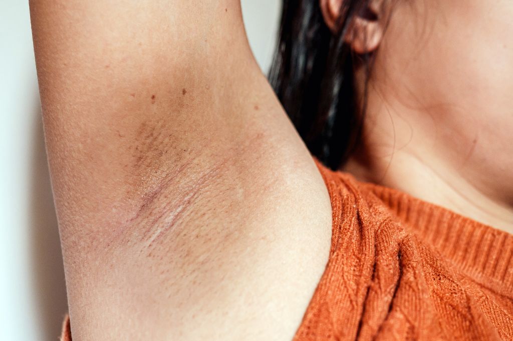 How To Treat An Armpit Rash And When To See A Dermatologist