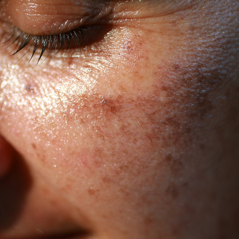 sun spots on cheek sun spots on cheek