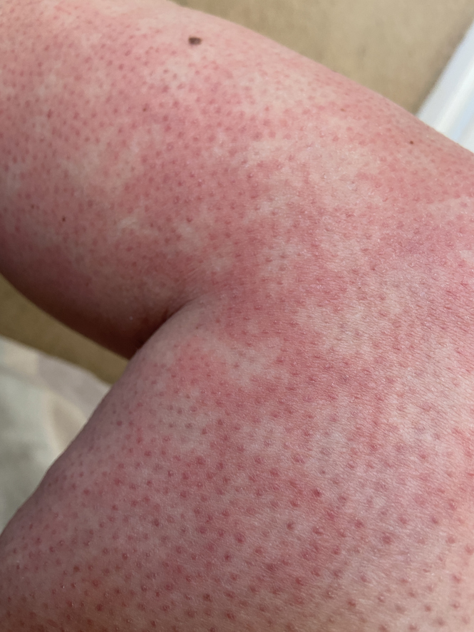 Toasted skin syndrome (erythema ab igne).jpg